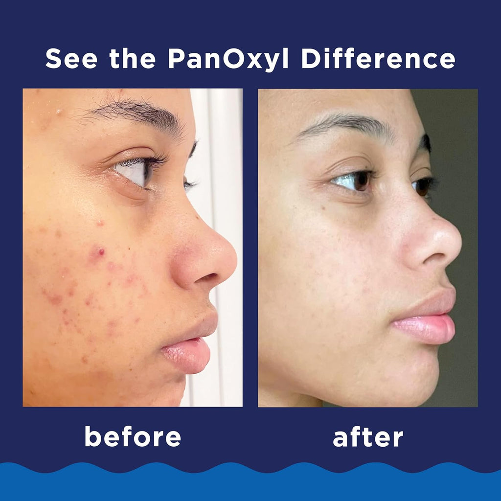 PanOxyl 10% Benzoyl Peroxide Acne Foaming Wash