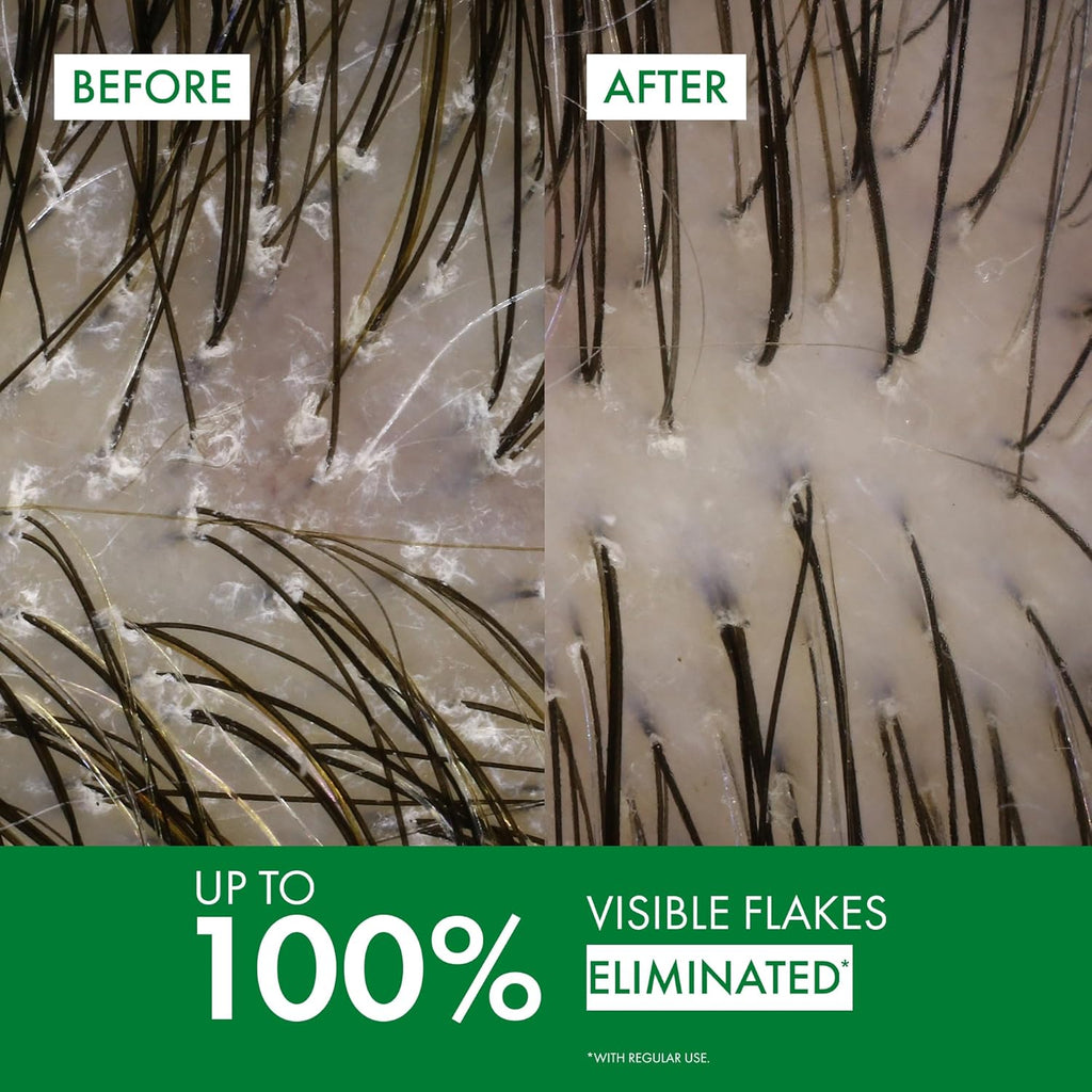 VICHY Dercos Anti Dandruff Scalp Treatment Shampoo