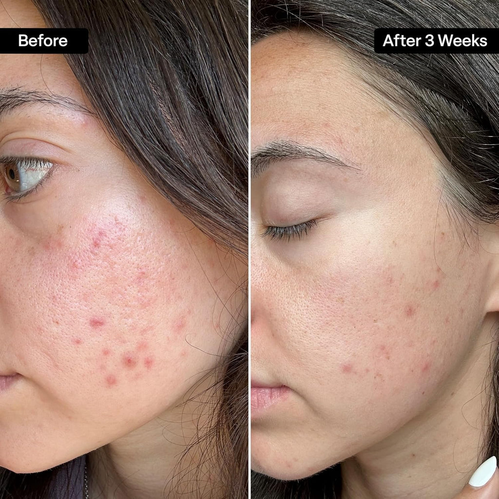 QRxLabs Acne Clearing Pads 50ct