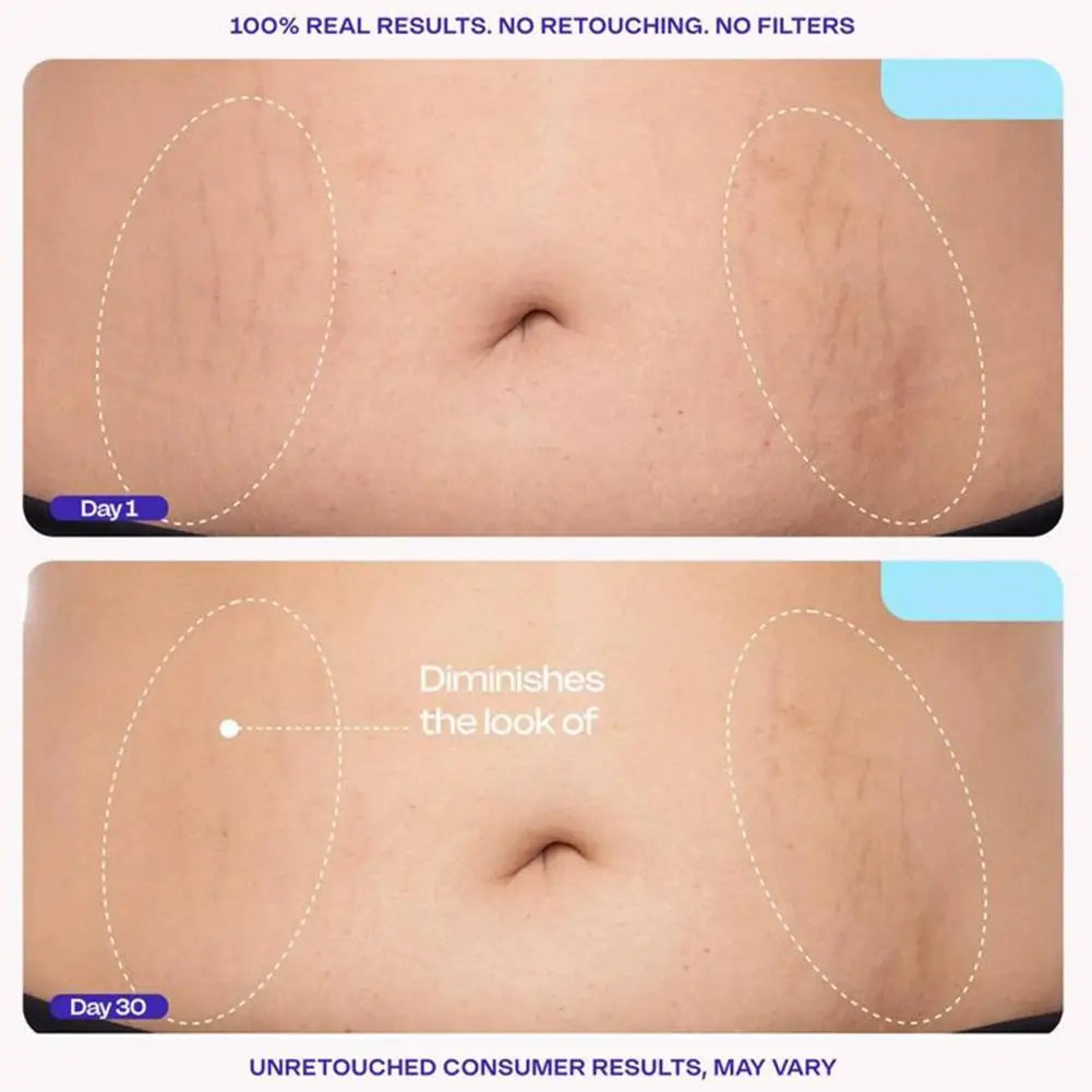 Postpartum Abdomen Firming Cream Stretch Marks Repair Essence Tightening Loose Skin Anti-Wrinkle Body Cream for Belly Smoothing