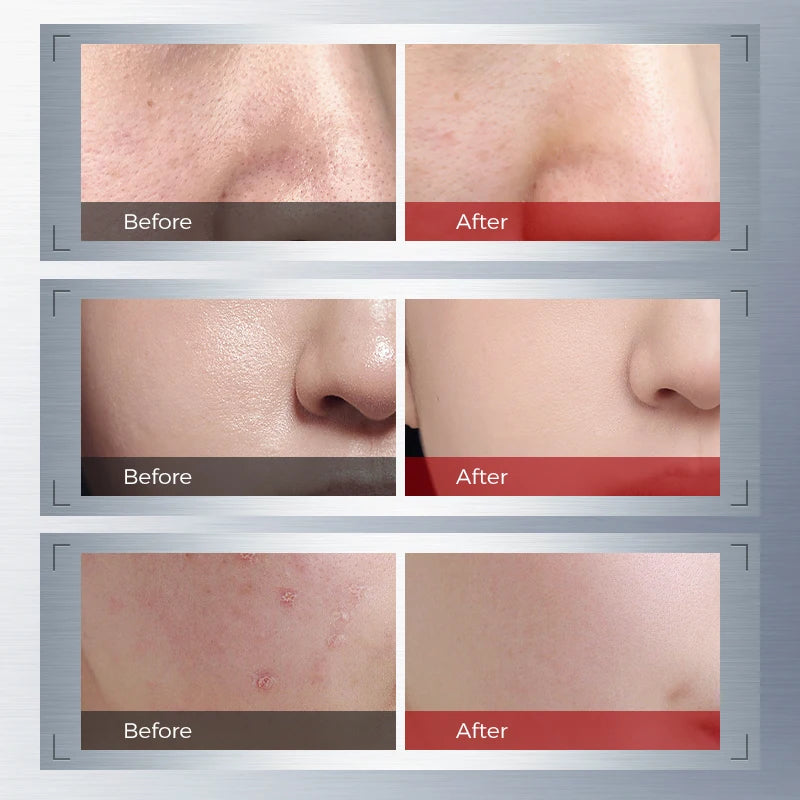 NING Ampoule Serum with 2% Salicylic Acid + Niacinamide – Skin Care for Oil Balance, Smooth-Looking Pores & Comfort