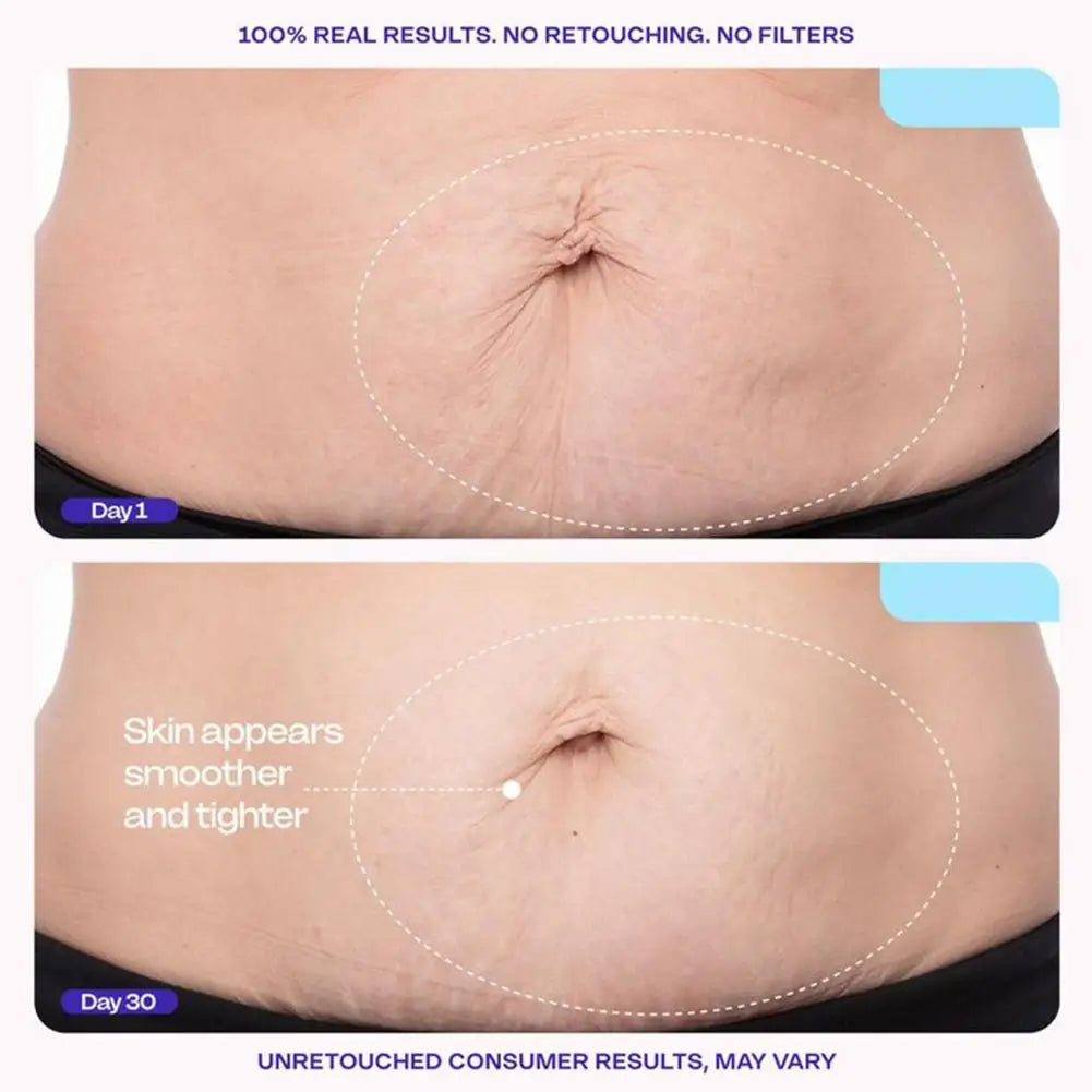 Postpartum Abdomen Firming Cream Stretch Marks Repair Essence Tightening Loose Skin Anti-Wrinkle Body Cream for Belly Smoothing
